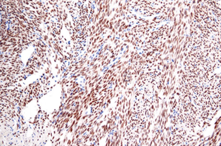 SS18-SSX Rabbit Monoclonal Antibody(ARM647)